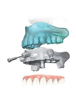 KEY-HOLE SURGERIES