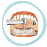 KEY-HOLE SURGERIES