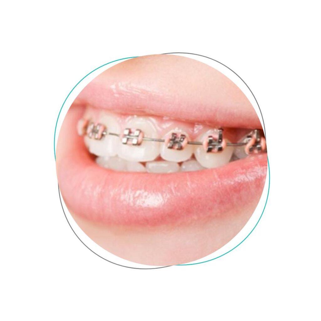 Aligners