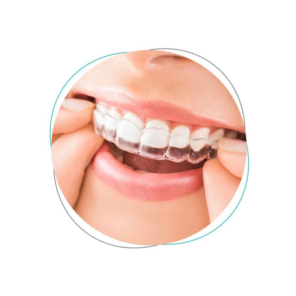 Aligners