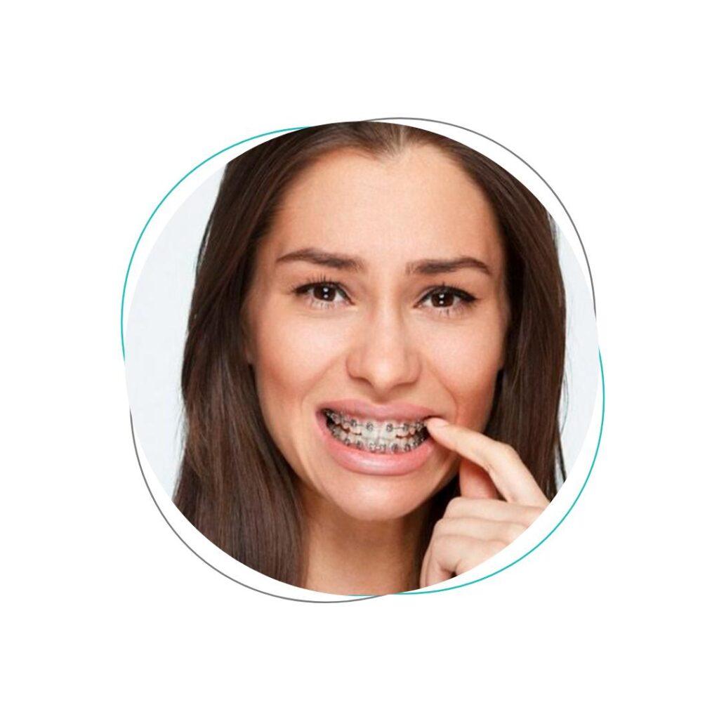 Aligners