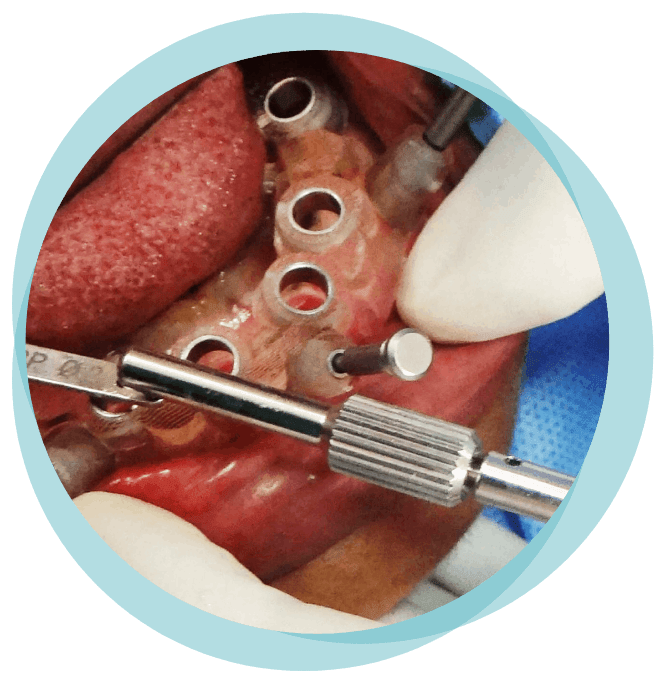 KEY-HOLE SURGERIES