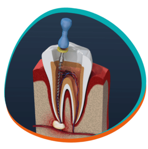 Root Canal Treatment