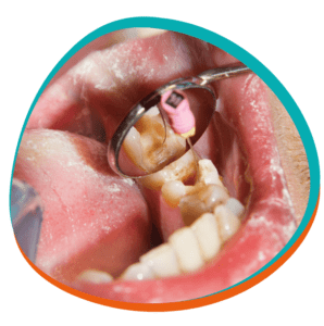 Root Canal Treatment