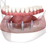 All-on-4 dental implant treatment is an innovative solution for replacing multiple missing teeth or a full arch of teeth with a fixed prosthesis supported by only four dental implants. This revolutionary approach offers several benefits, including improved stability, functionality, and aesthetics compared to traditional dentures.