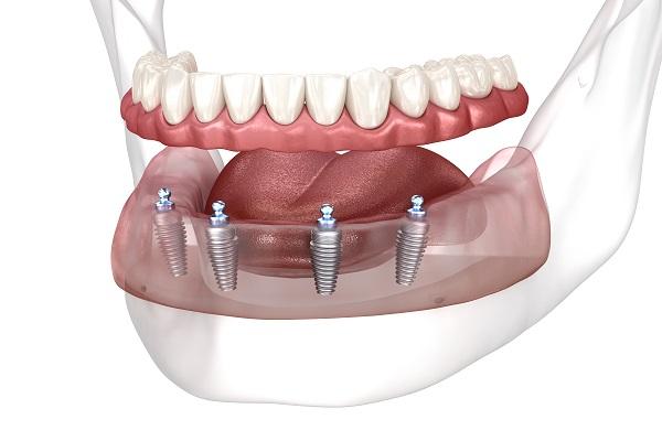 You are currently viewing Dental Implant Treatment