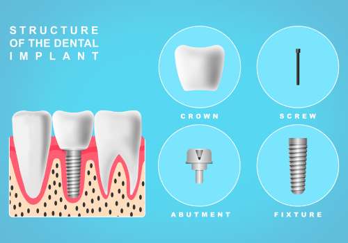 single tooth replacement with dental implants in hyderabad. Cost of dental implant in hyderabad, dental implant procedure. Dental implant treatment risks,