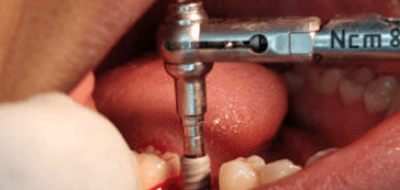 Implant Dentistry