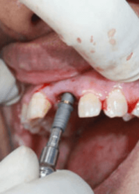 Implant dentistry