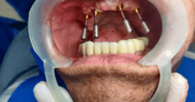 Implant Dentistry