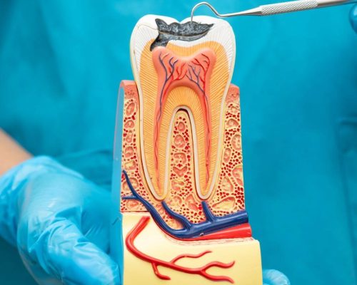 Root-canal-treament-kosmo-dental-clinic-hyderabad (1)