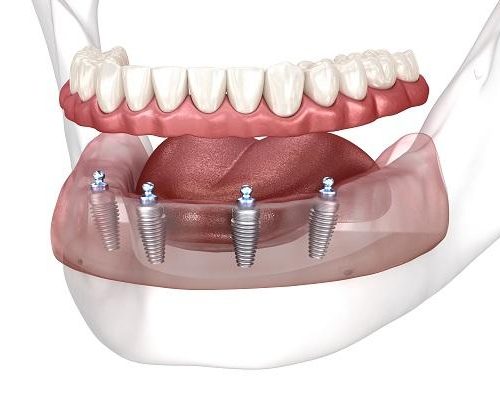 All-on-4 dental implant treatment is an innovative solution for replacing multiple missing teeth or a full arch of teeth with a fixed prosthesis supported by only four dental implants. This revolutionary approach offers several benefits, including improved stability, functionality, and aesthetics compared to traditional dentures.